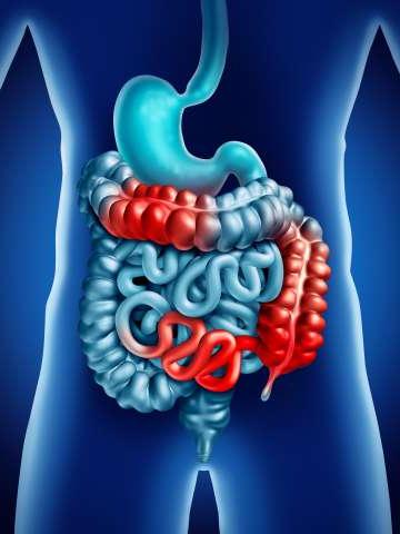 Inflammatory Bowel Diseases (IBD)